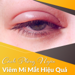 Cách Phòng Ngừa Viêm Mí Mắt Hiệu Quả