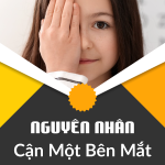 Nguyên Nhân Và Cách Xử lý Cận Một Bên Mắt